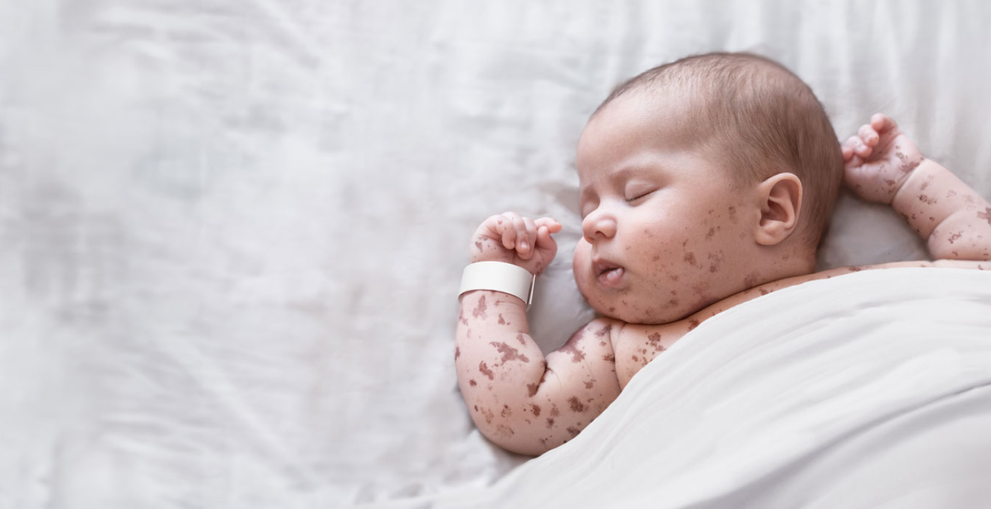 Baby with a promonent red rash, sleeping in a bed